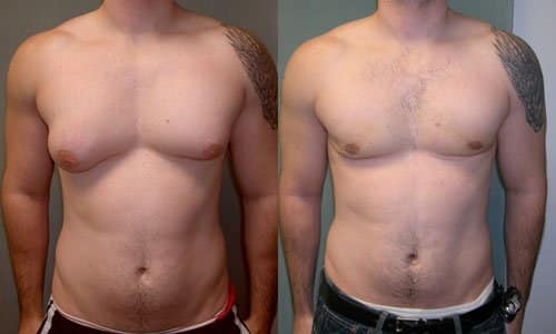 Asymmetric_Gynecomastia